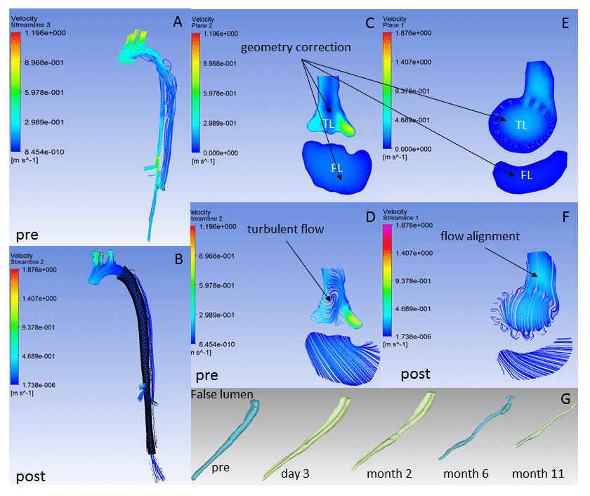 Figure. True aortic luminal flow increased and stabilized and false lumen volume and flow was reduced in post MFM implantation (panels B, E, F & G). Aortic velocity stream lines turbulent pre (panels A, C & D) became more aligned at the arch and bifurcation commensurate with false lumen volume reduction.