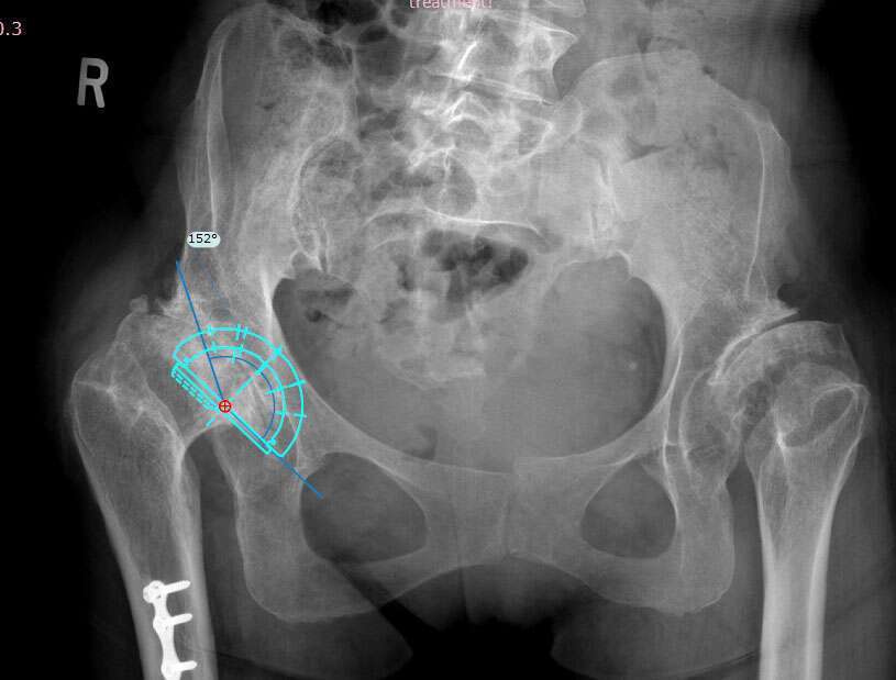 In this Hartofilakidis type 2 case, the preoperative templated coverage angle was 152º, or 84.4% coverage 