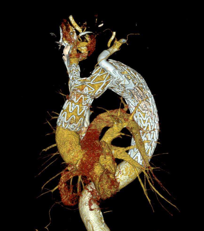 Nexus implanted graft