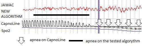 Apnea recognition timing by both signals