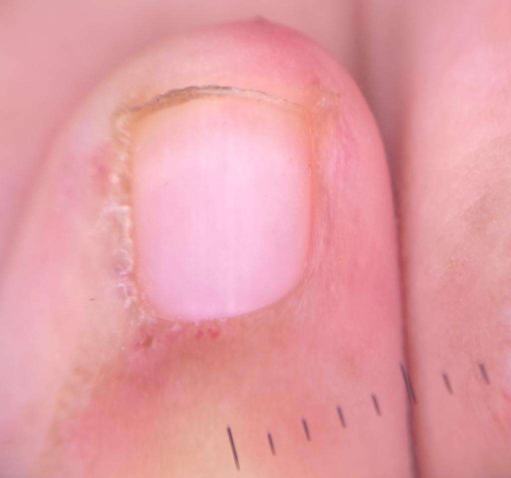 Figure 4. Telangiectases evident in the proximal nail fold.