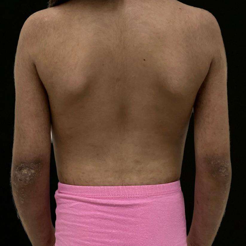 Figure 3. Generalized xerosis, scaly plaques on both elbows.