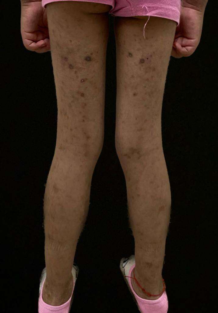 Figure 5. Multiple scarring pigmented plaques and macules on both lower limbs