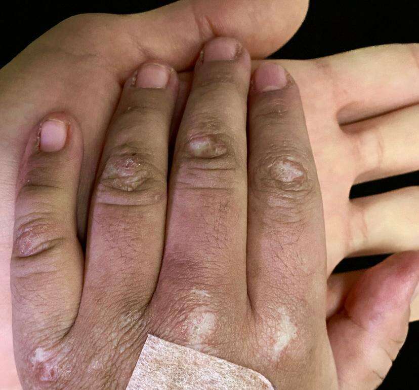 Figure 2. Gottron papules on knuckles of the left hand