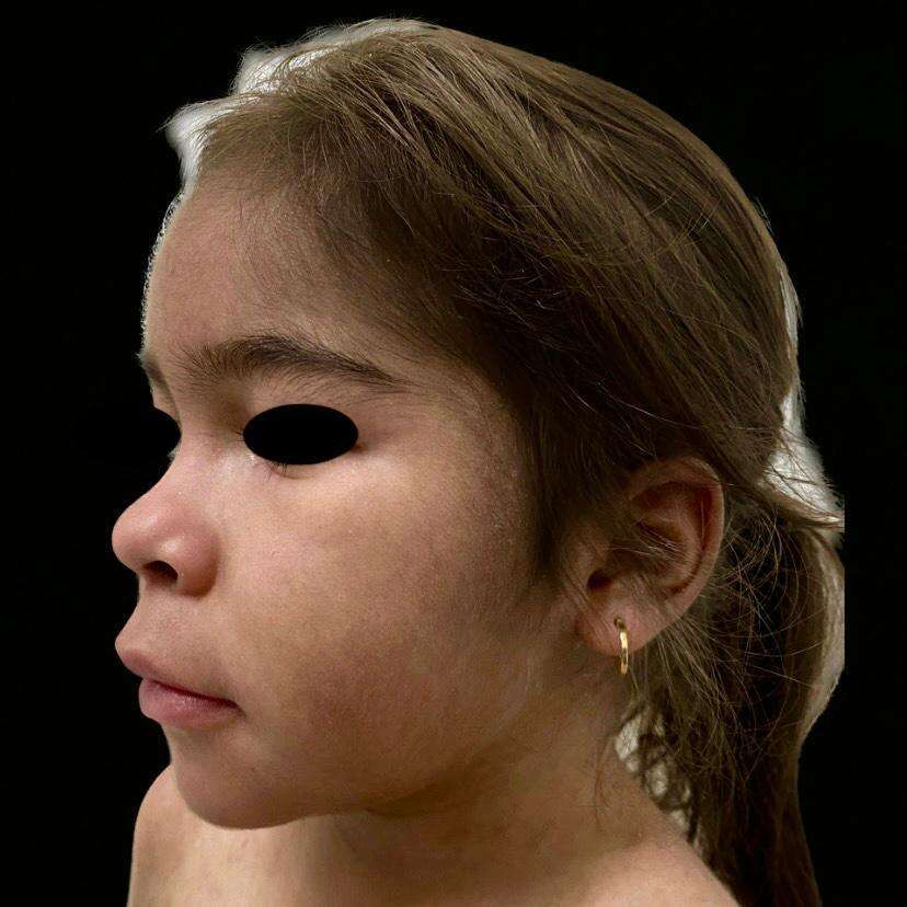 Figure 1. Eyelid edema, hypertrichosis, red and dark brown macules on the left cheek