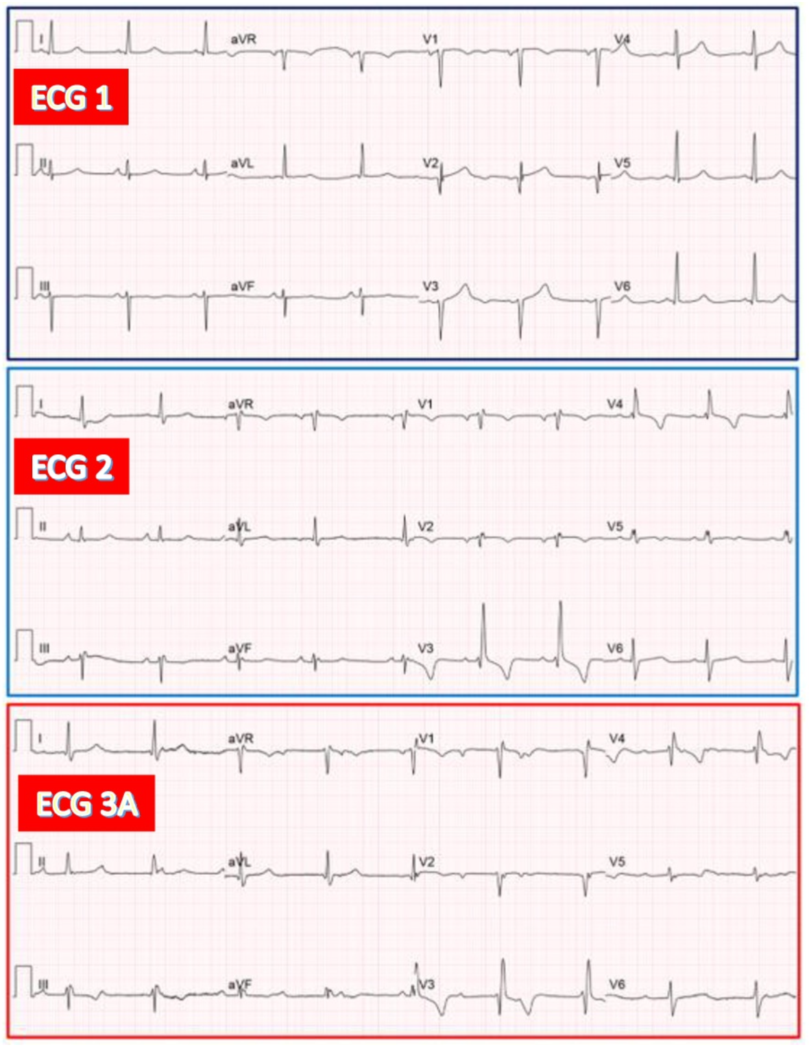 AV junctional escape rhythm with RBBB during CAVB in an 83-year-old woman exhibiting RBBB after TAVR