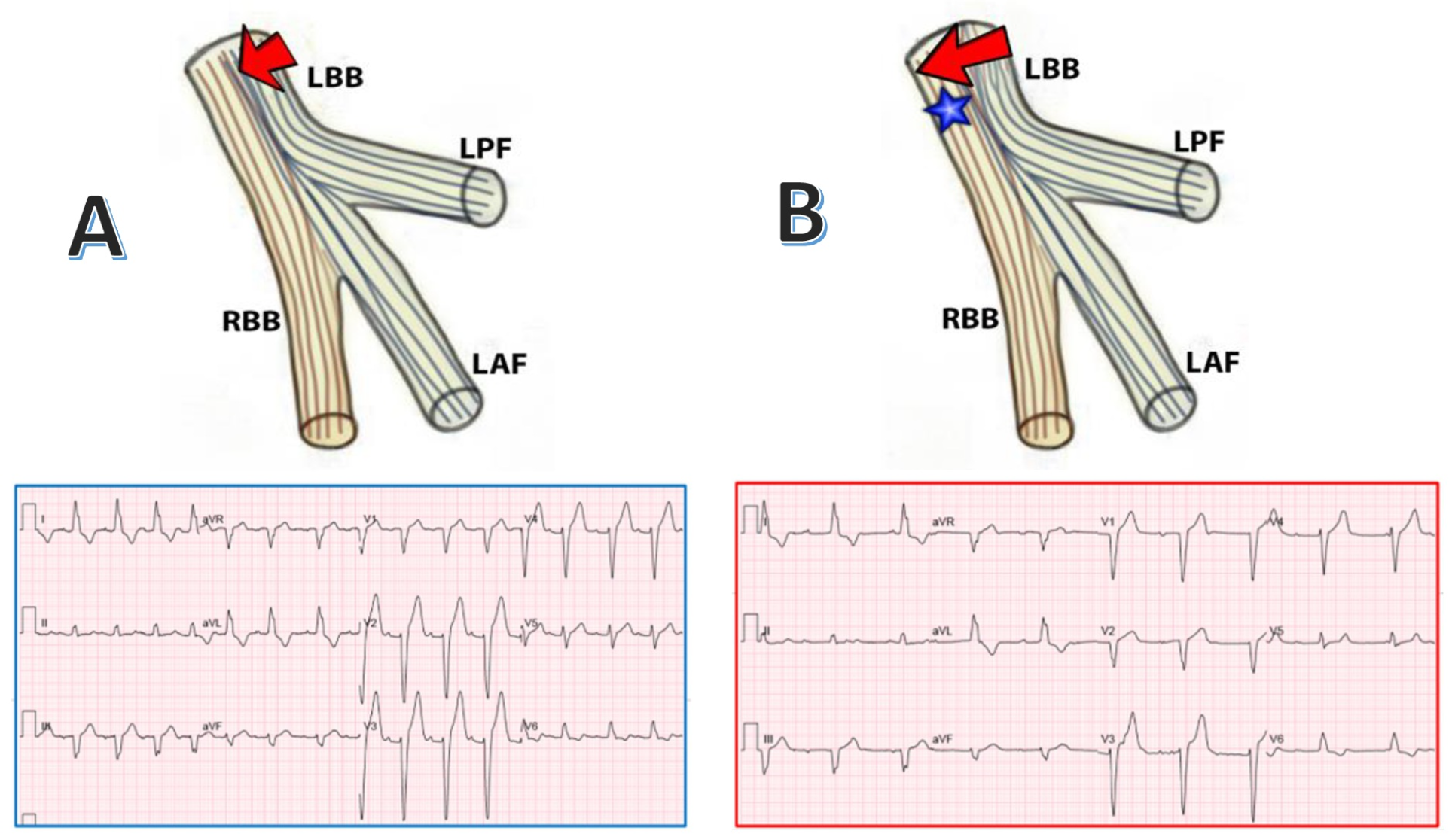 Potential mechanism for AV junctional rhythm following TAVR induced LBBB relying on the theory of longitudinal dissociation of the His bundle.