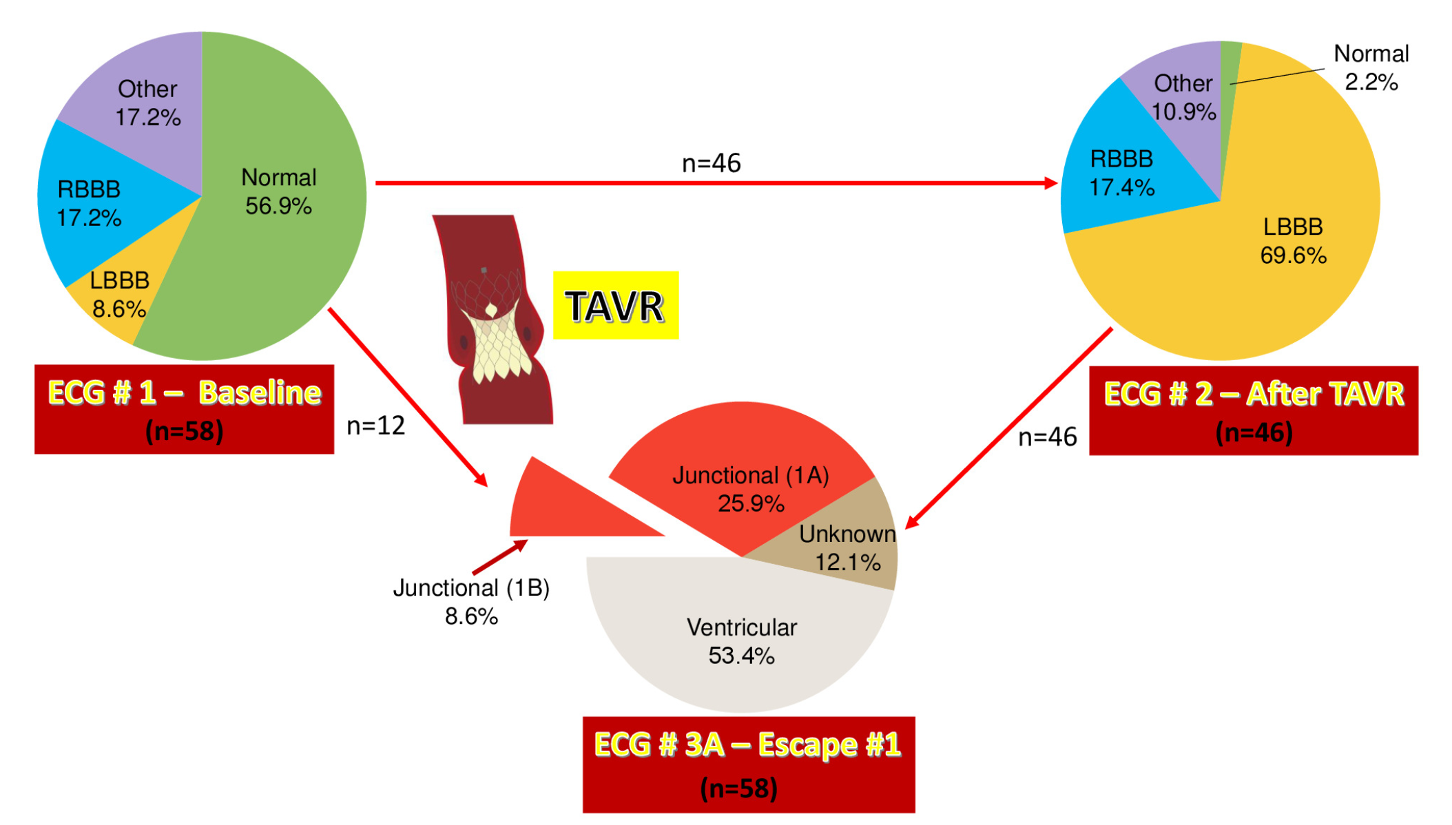 Distribution of the conduction disturbances before and after TAVR and presumed origin of the escape rhythm during CAVB in the 58 study patients