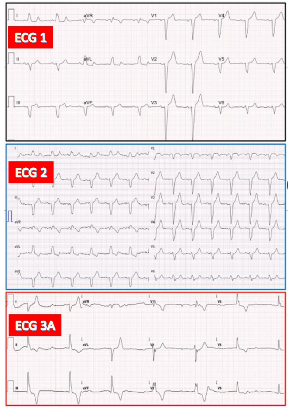 Ventricular escape rhythm with RBBB pattern during CAVB in an 88-year-old woman exhibiting LBBB both before and after TAVR.