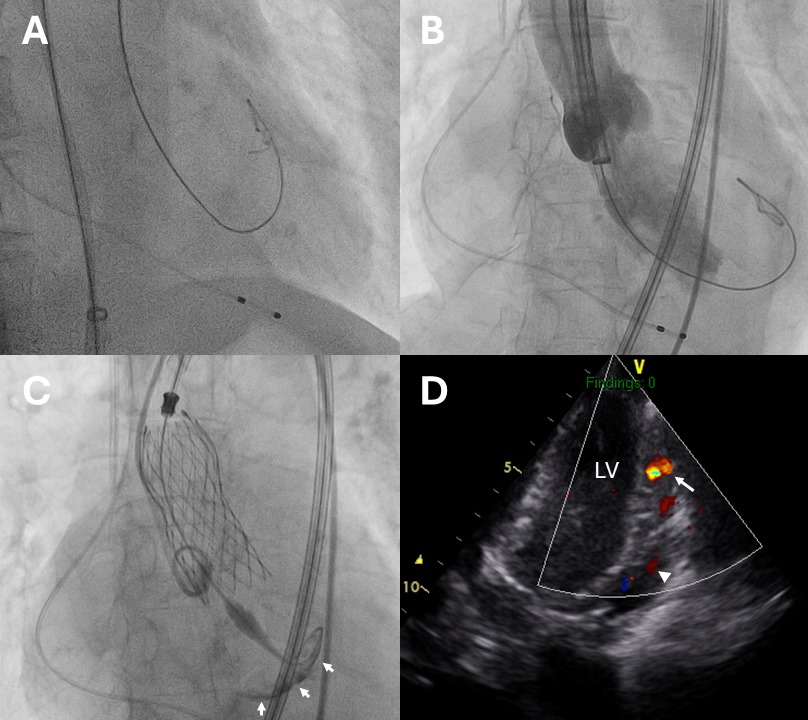 Left ventricle (LV) wire perforation: A) Fluoroscopic image of the stiff guidewire, presumably located within the LV cavity (right anterior oblique view), B) Aortogram during valve positioning: regurgitated contrast media filling the LV cavity, tip of guidewire located outside of  LV (left anterior oblique view), C) Fluoroscopic image following valve deployment-contrast media staining at LV apex (arrows), D) Color Doppler echocardiography (apical view) showing blood flow (arrow) from the LV to the pericardial space (arrowhead).