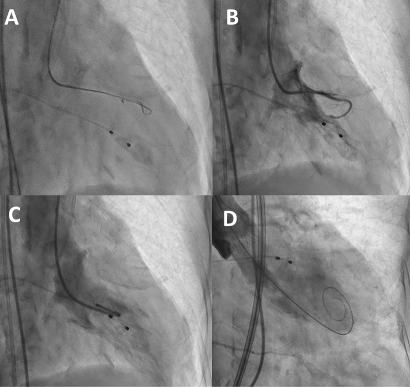 Left ventriculography for guiding guidewire position: A) Fluoroscopic image of initial guidewire position following insertion across the aortic valve, B) Ventriculography using gentle manual injection, showing tip of catheter behind a muscular trabeculae C) Repeat ventriculography following catheter repositioning within the LV cavity, D) Guidewire located within LV apex during valve deployment.