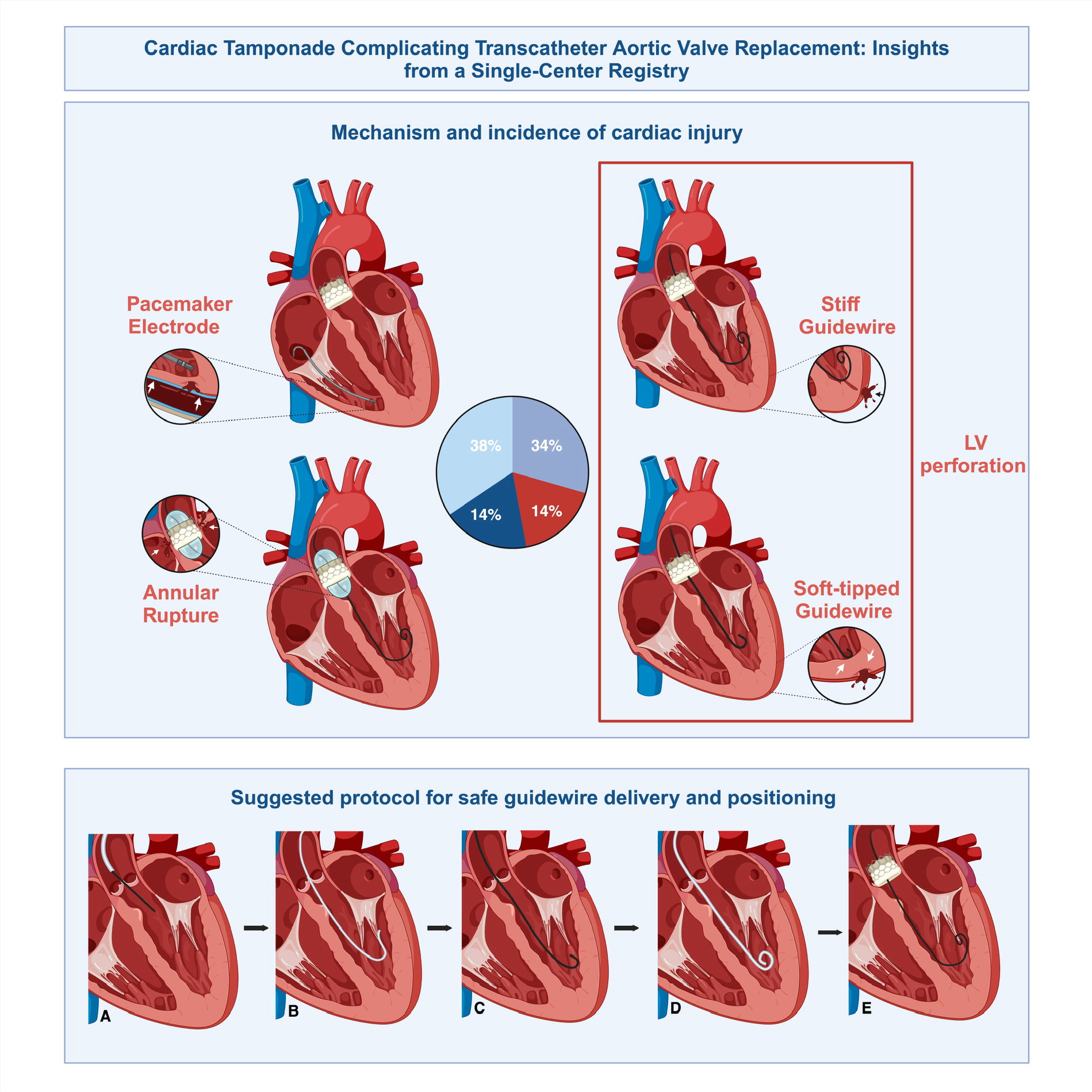 Central Illustration: Cardiac tamponade during transcatheter aortic valve replacement (TAVR): Upper panel: Mechanism and incidence of cardiac injury among patients with tamponade. Lower panel: Suggested protocol for safe guidewire positioning within the left ventricle: A) Straight-tipped 0.035” soft guidewire inserted via an Amplatz-Left (AL) catheter across the stenosed aortic valve, B) AL catheter advanced over the straight-tipped guidewire, positioned in left ventricle (LV). Blood backflow from its rear end is verified, C) J-tipped soft guidewire advanced via the AL catheter and positioned within the LV, D) Pigtail catheter carefully advanced over the J-tipped guidewire and positioned within the LV. Gentle manual LV angiogram confirms pigtail catheter optimal location, E) Stiff guidewire advanced via pigtail catheter, positioned within the LV cavity and used for delivering the transcatheter heart valve to the implantation site.