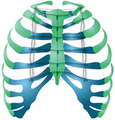 Schematic illustration of bilateral longitudinal stainless-steel sternal wires along the intact ribs with horizontal sternal wires, inserting laterally to the longitudinal wires, directly into the middle of each rib
