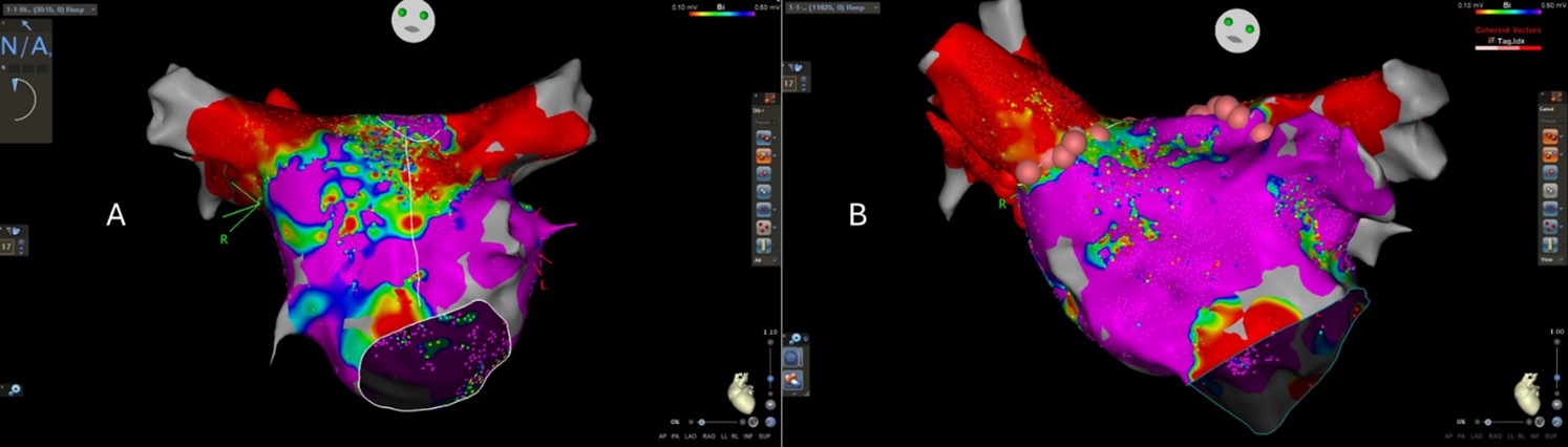 Figure 1. A – Bipolar Voltage map in atypical atrial flutter. B – Bipolar Voltage map in a patient with atrial fibrillation in sinus rhythm