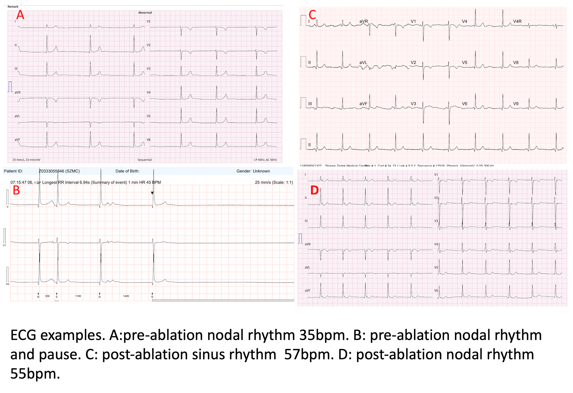 ECG examples