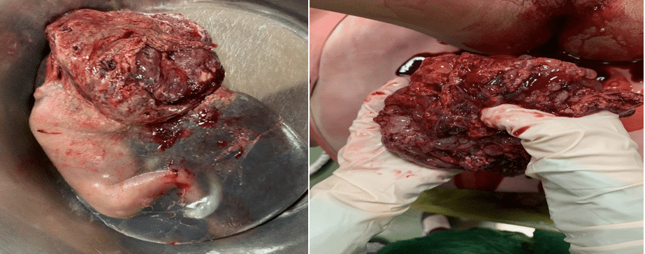 Abortus (200g) with a normal placenta followed by passage of vesicular tissues approximately 600cc. Suction curettage done with estimated blood loss of 600cc