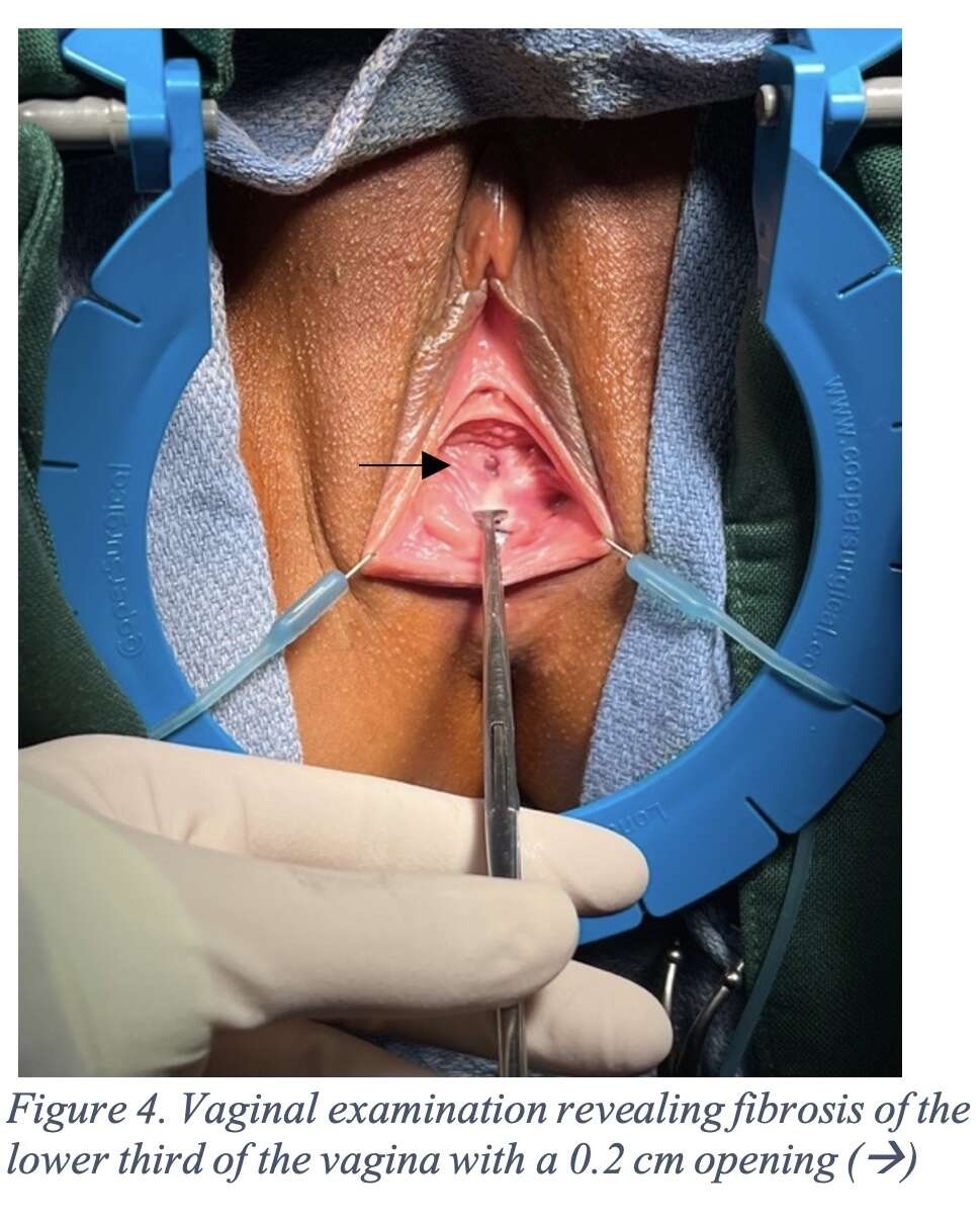 Vaginal examination revealing fibrosis of the lower third of the vagina with a 0.2 cm opening 