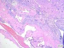 Placenta accreta, villi implanting on the myometrial surface without intervening decidua