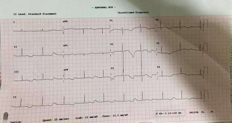 Post stellate ganglion block ECG showing LQTS