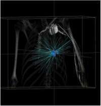 stereotactic radiosurgery