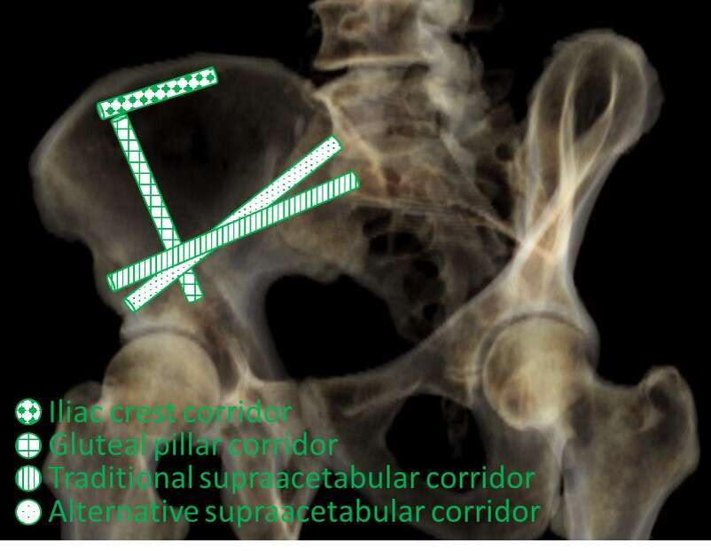 Supraacetabular, gluteal pillar, iliac crest osseous corridors