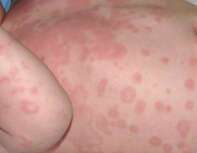 Hives in insect sting induced anaphylaxis
