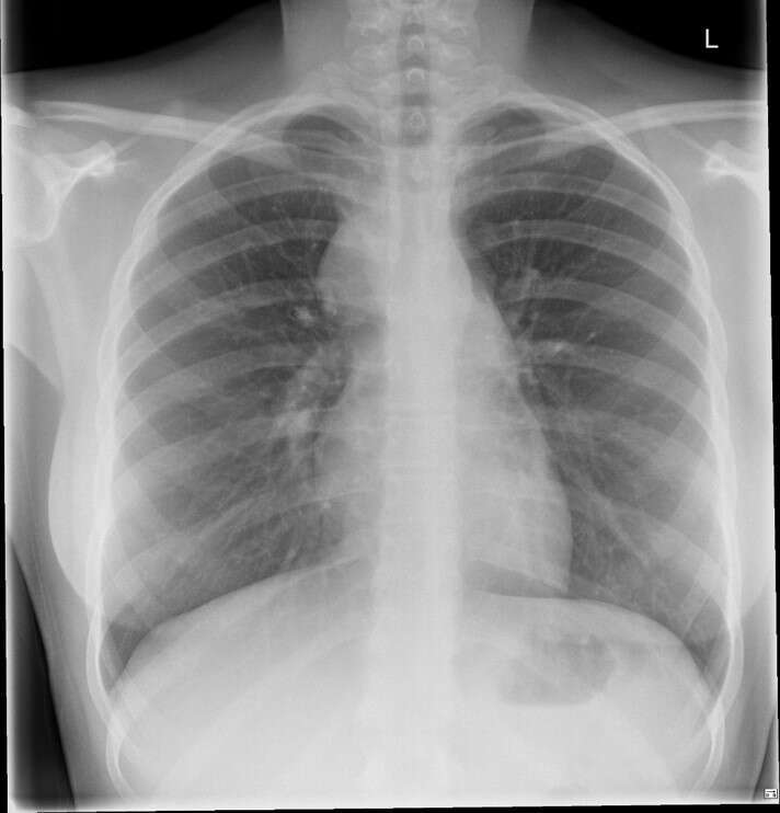 Chest X-ray showing mediastinal enlargement