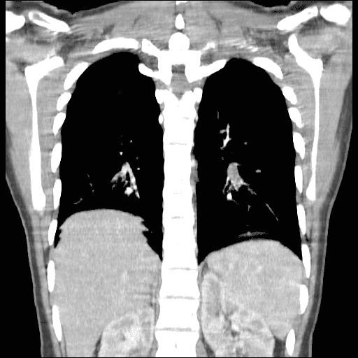 Thorax CT scan showing a filling defect in a branching subsegmental artery