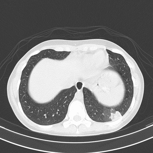 Thorax CT scan showing a wedge shaped peripheral opacity of lung parenchyma in the left lower lobe