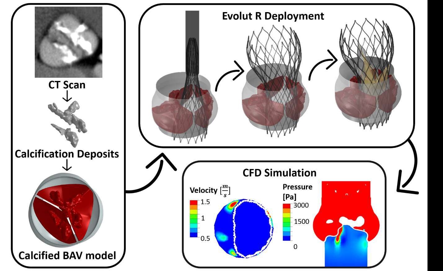 Computed tomography scan of severely stenotic bicuspid aortic valve (BAV) patient was acquired. The 3D calcium deposits were generated and embedded inside a parametric model of the BAV. Deployments of the Evolut R and PRO inside the calcified BAV were simulated. The cuff and closed bio-prosthetic leaflets were added to the deployed stent to obtain the diastolic state. The resulted structural geometry was utilized for computational fluid dynamics simulations to calculate the paravalvular leakage. 