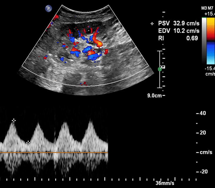 During vascular assessment of the kidney transplant, the Resistive Index ( RI) values were normal in all areas of the transplanted kidney. RI Indexes were within the normal range, between 0.66 to 0.69. No ‘Parvus Tardus’ pattern was present. 