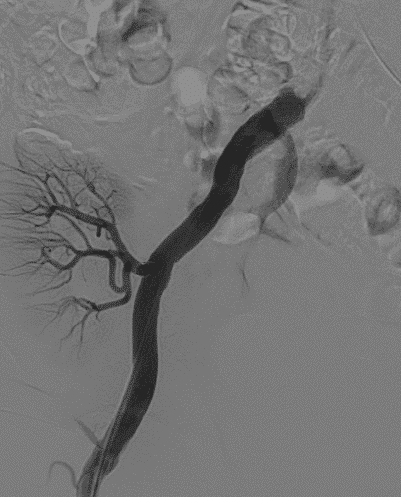 After the procedure,  full patency of the previously stenotic lesion, as well as good perfusion of the renal arteries up to its distal small branches within the transplant