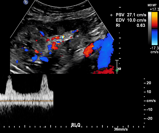 Follow-Up ultrasound POD1, shows immediate and complete normalization of the Doppler pattern,