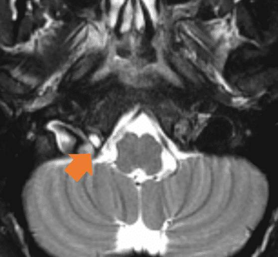 Benign hypoglossal canal nonenhancing cystic lesions