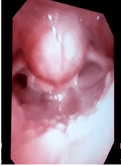 Figure 1 (vallecular cyst displacing the epiglottis by flexible bronchoscopy)   