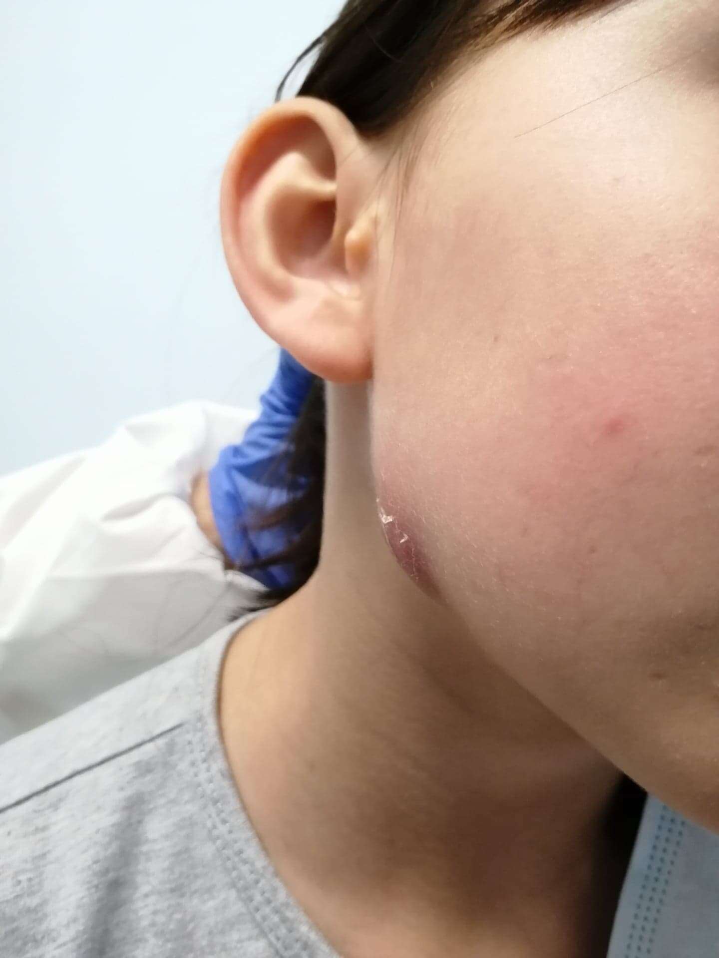 Cutaneous odontogenic fistula