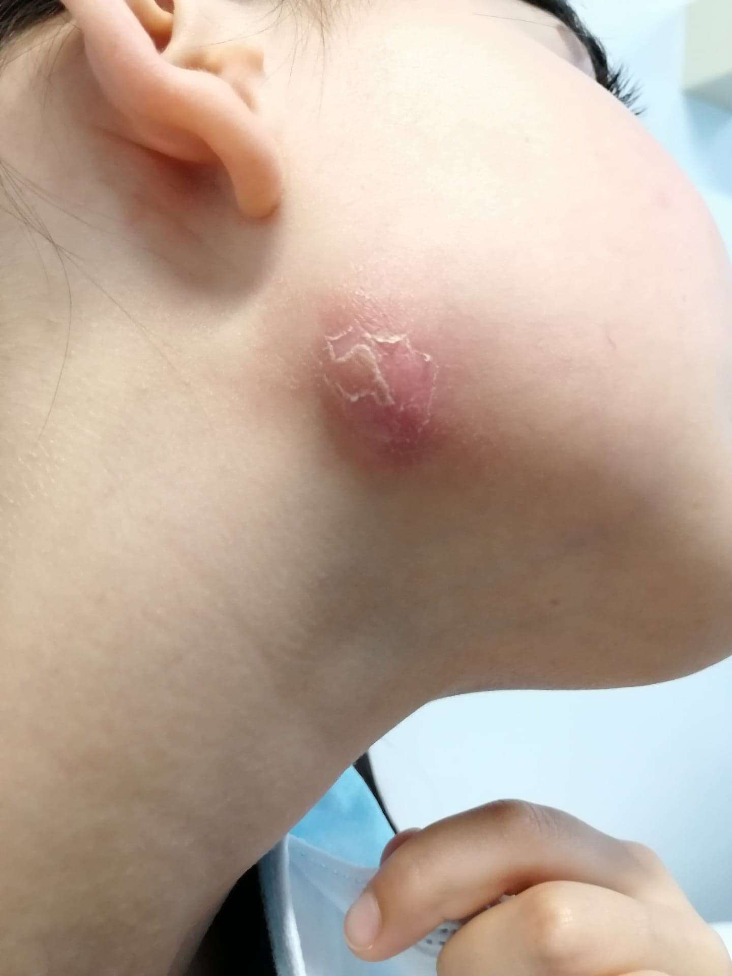 Cutaneos odontogenic fistula