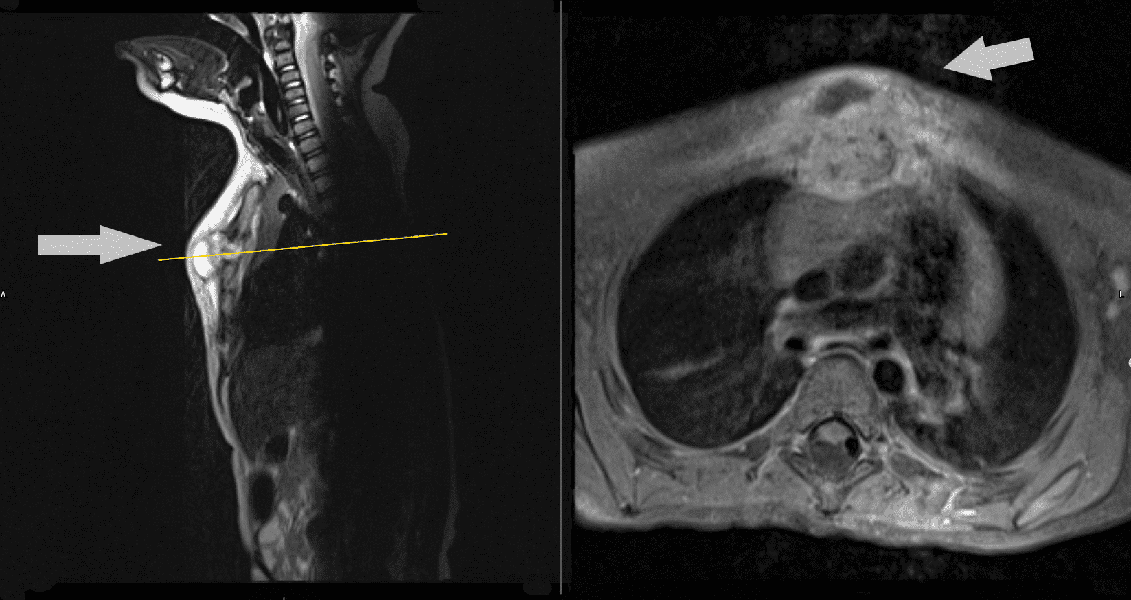 Figure 2. Sagital T2 and axial T1 MRI images of BCG sternum lesion