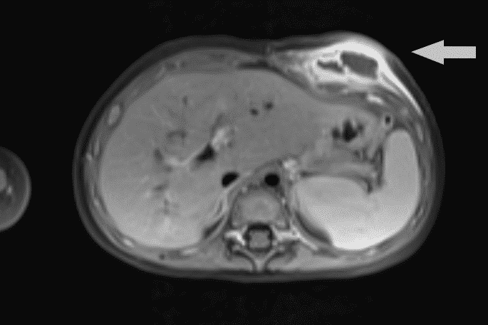 Figure 3. . Axial T1 MRI image of the chest at presentation demonstrating BCG induced inflammatory lesion.