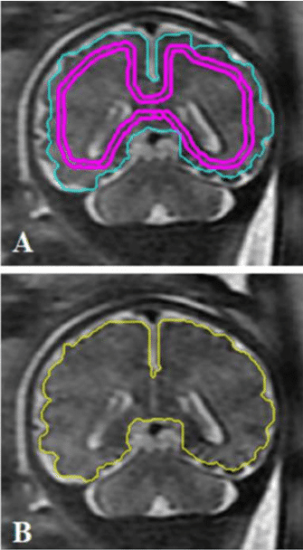 A, Initial contour of the ROI drawn manually on the midcoronal Section in pink, and the contour automatically propagated by the algorithm in light blue. B, Manual changes are made to attain maximal precision, in yellow. 