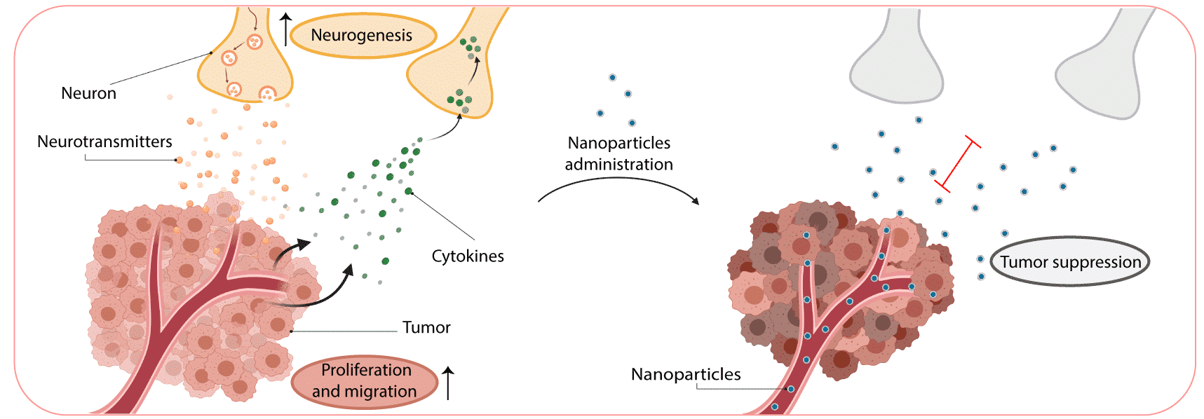 Analgesic nanoparticles as a tool for treating neurons within breast cancer tumors