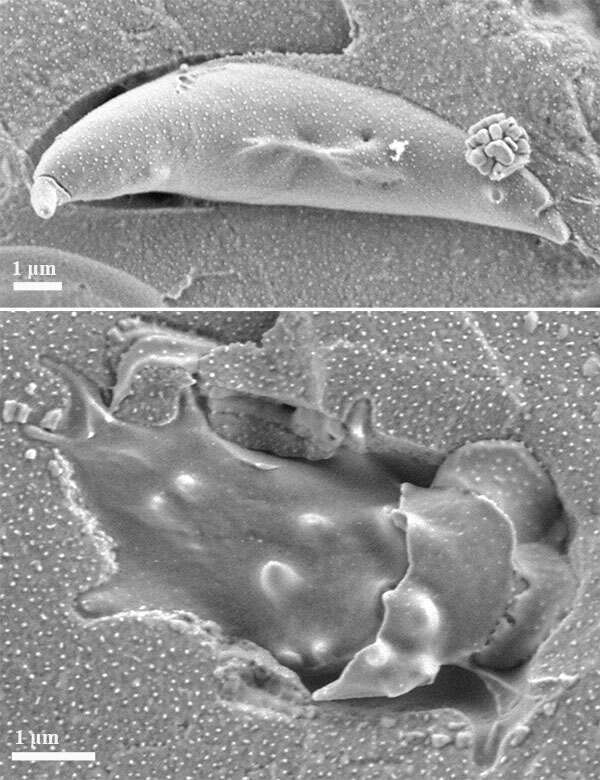 The pictures show cryo-SEM micrographs of the RBC sample collected from a patient with sickle cell disease (HbS/β-thalassemia). The sample was incubated overnight with 15% (w/v) sodium metabisulfite to mimic the condition of hypoxia. Top: sickled cell; Bottom: acanthocyte with partially removed cell membrane. The samples were prepared using high pressure freezing. The imaging was performed on Zeiss Ultra-plus HR-SEM using ET and InLens detectors with 1:1 mixed signals. The specimens were maintained at -145 °C, and imaged without coating at an acceleration voltage of 1.2 kV, and under low-dose imaging conditions.